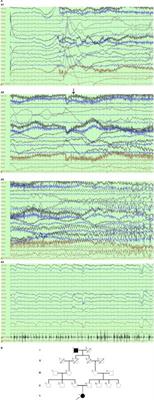 Homozygous TBC1D24 Mutation in a Case of Epilepsia Partialis Continua